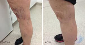 Leg Vein Treatment with Sclerotherapy