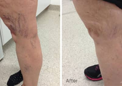 Leg Vein Treatment with Sclerotherapy