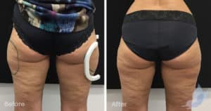 Coolsculpting spot fat reduction