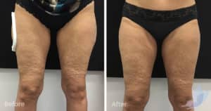 Coolsculpting spot fat reduction