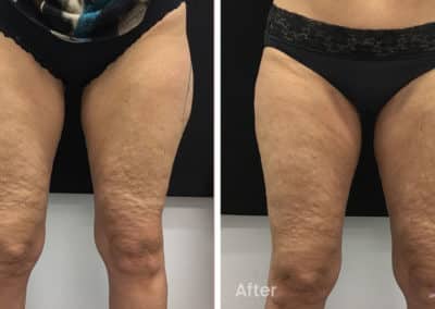 Coolsculpting spot fat reduction