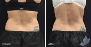 Coolsculpting spot fat reduction