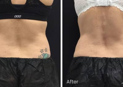 Coolsculpting spot fat reduction