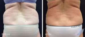 Coolsculpting spot fat reduction