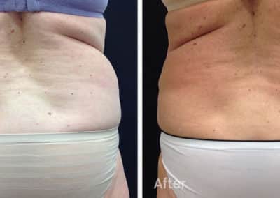 Coolsculpting spot fat reduction