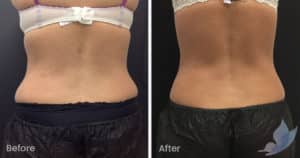 Coolsculpting spot fat reduction