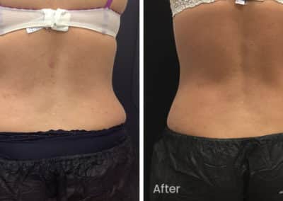 Coolsculpting spot fat reduction