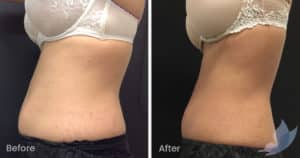 Coolsculpting spot fat reduction