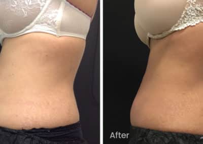 Coolsculpting spot fat reduction