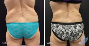 Coolsculpting spot fat reduction