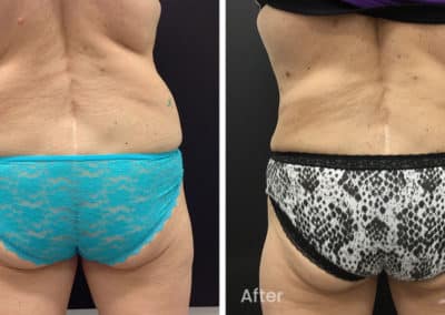 Coolsculpting spot fat reduction