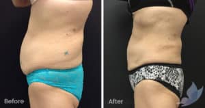 Coolsculpting spot fat reduction