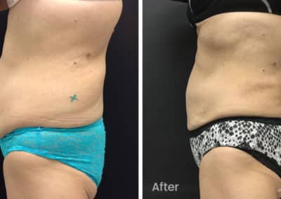 Coolsculpting spot fat reduction