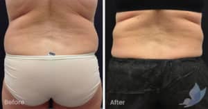 Coolsculpting spot fat reduction