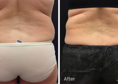 Coolsculpting spot fat reduction