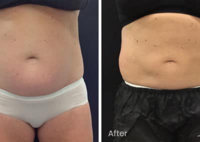 Coolsculpting spot fat reduction