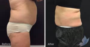 Coolsculpting spot fat reduction