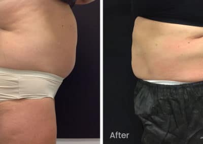 Coolsculpting spot fat reduction