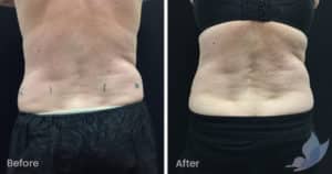 Coolsculpting spot fat reduction