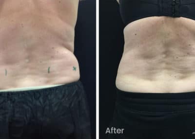 Coolsculpting spot fat reduction