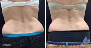 Coolsculpting spot fat reduction