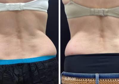 Coolsculpting spot fat reduction