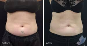 Coolsculpting spot fat reduction