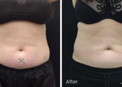 Coolsculpting spot fat reduction