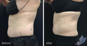 Coolsculpting spot fat reduction