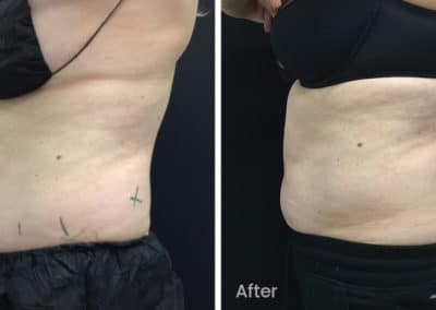 Coolsculpting spot fat reduction