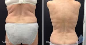 Coolsculpting spot fat reduction