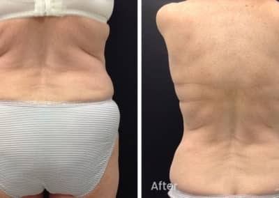 Coolsculpting spot fat reduction