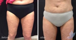 Coolsculpting spot fat reduction