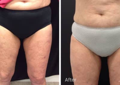 Coolsculpting spot fat reduction