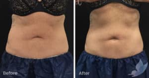 Coolsculpting spot fat reduction