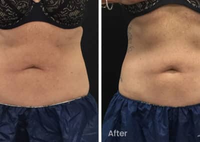 Coolsculpting spot fat reduction