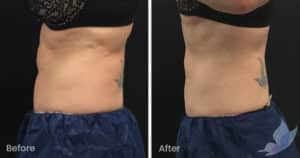 Coolsculpting spot fat reduction