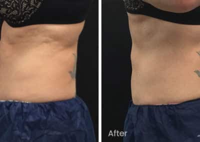 Coolsculpting spot fat reduction