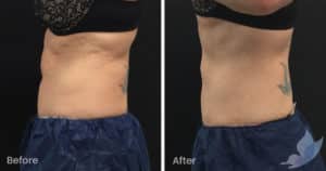 Coolsculpting spot fat reduction