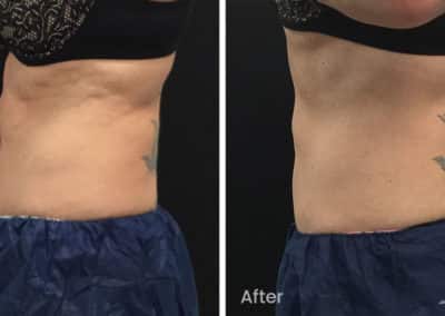 Coolsculpting spot fat reduction