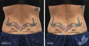 Coolsculpting spot fat reduction