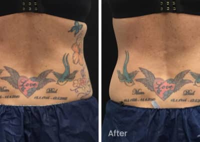 Coolsculpting spot fat reduction