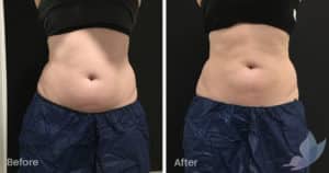 Coolsculpting spot fat reduction