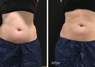 Coolsculpting spot fat reduction