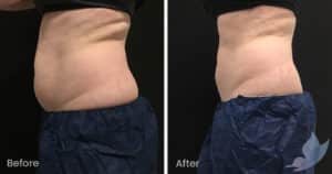 Coolsculpting spot fat reduction