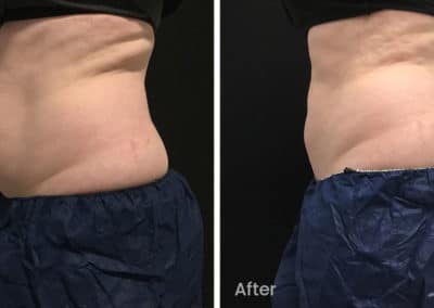 Coolsculpting spot fat reduction