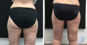 Coolsculpting spot fat reduction