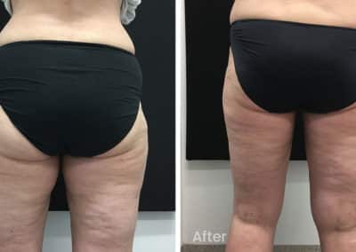 Coolsculpting spot fat reduction