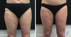 Coolsculpting spot fat reduction