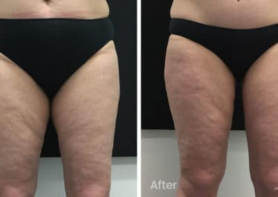 Coolsculpting spot fat reduction